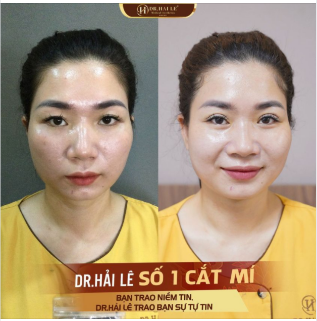 CẮT MÍ - THAY ĐỔI VẺ ĐẸP "CỬA SỔ TÂM HỒN".!!!