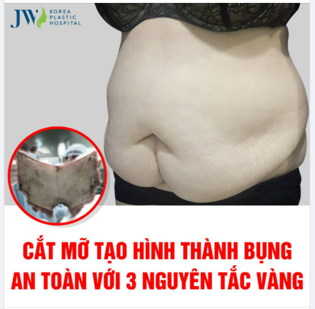 CẮT MỠ TẠO HÌNH THÀNH BỤNG AN TOÀN VỚI 3 NGUYÊN TẮC VÀNG