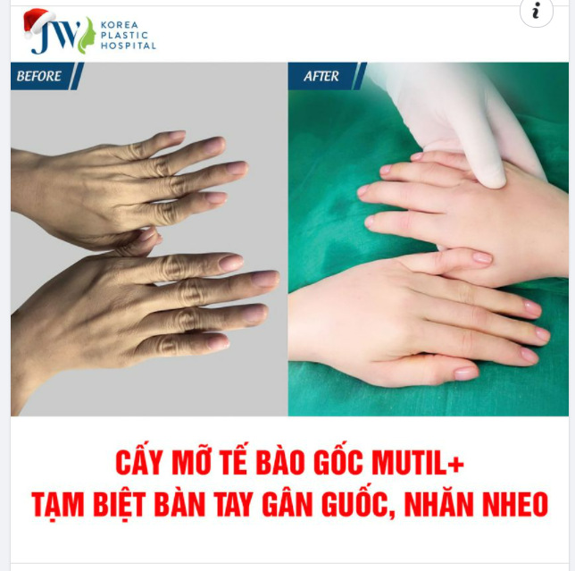 CẤY MỠ TẾ BÀO GỐC MUTILᐩ BÍ QUYẾT ĐÁNH BAY BÀN TAY GÂN GUỐC, NHĂN NHEO