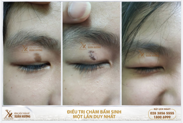 CHÀM BỚT BẨM SINH TRÊN MÍ MẮT HẾT SẠCH CHỈ CẦN 1 LẦN DUY NHẤT