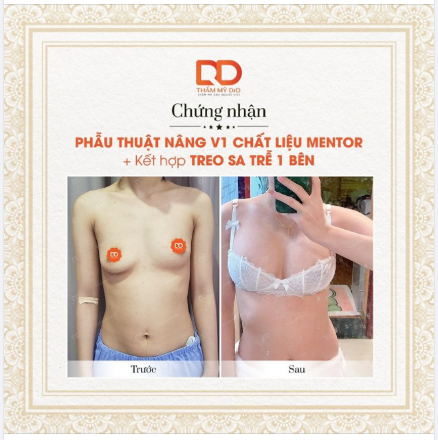 Chứng nhận từ DrD: Đã phẫu thuật Nâng V1