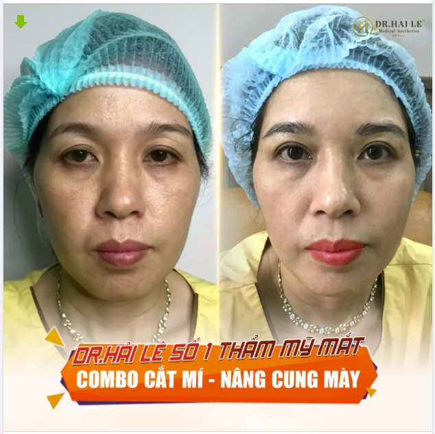 Combo Cắt mí Nâng cung mày - Dr.Hải Lê số 1 thẩm mỹ mắt.!