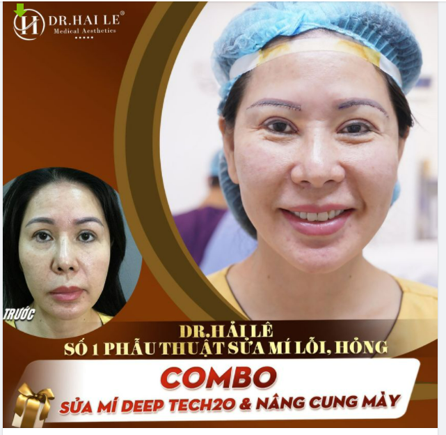 Combo sửa mí Deep Tech20 Nâng cung mày - Dr.Hải Lê số 1 phẫu thuật sửa mí lỗi, hỏng