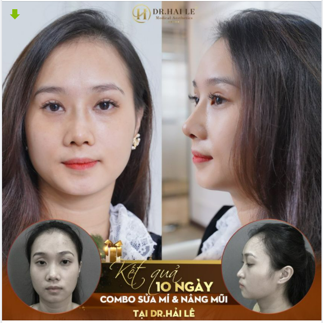 Combo sửa mí Deep Tech20 Nâng mũi Demi 5D - Bạn trao niềm tin, Dr.Hải Lê trao ban sự tự tin