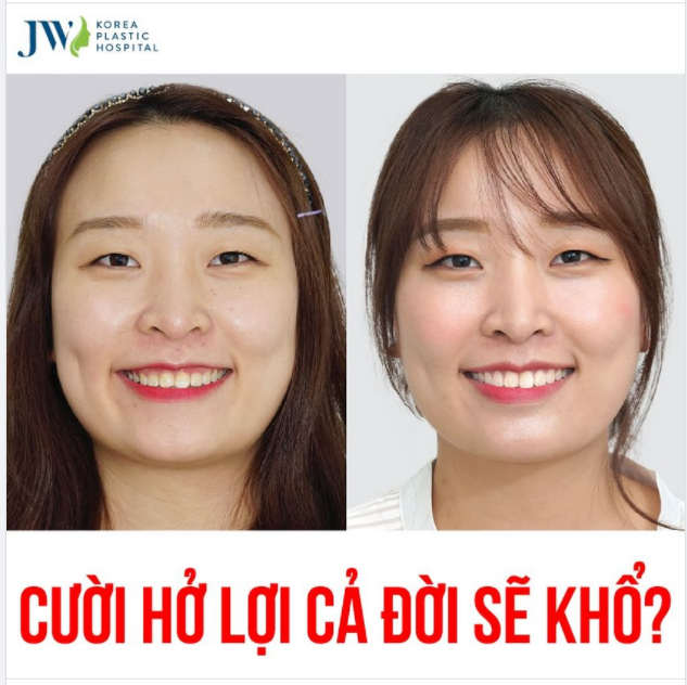 CƯỜI HỞ LỢI CẢ ĐỜI SẼ KHỔ?