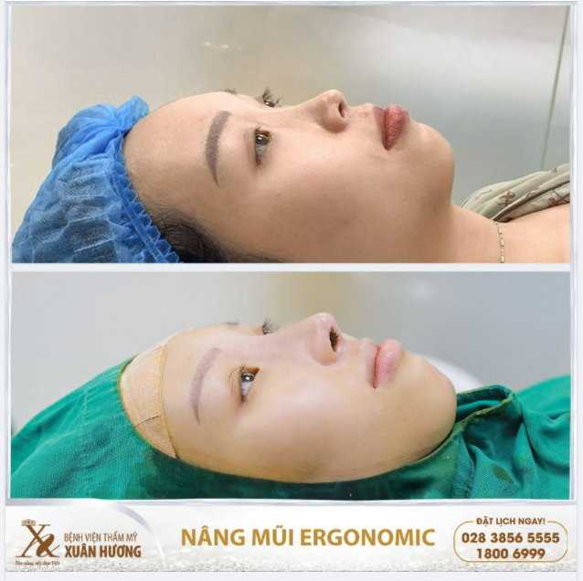 DA MŨI MỎNG, SỐNG MŨI THẤP - LỰA CHỌN DÁNG MŨI NÀO ĐỂ ĐẠT HIỆU QUẢ NÂNG MŨI TỐI ƯU?