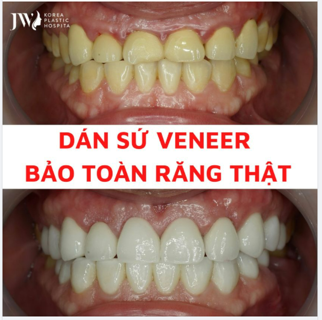 Dán sứ Veneer - Đỉnh cao công nghệ bảo toàn răng thật!