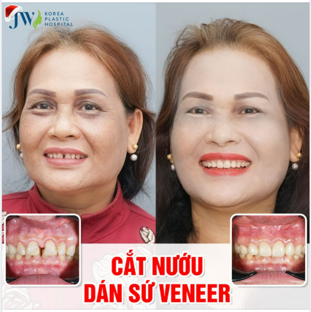 DÁN SỨ VENEER - TẤM VÉ ĐƯA QUÝ BÀ U50 TRỞ LẠI THỜI THANH XUÂN TƯƠI ĐẸP VỚI NỤ CƯỜI RẠNG RỠ - TỰ TIN