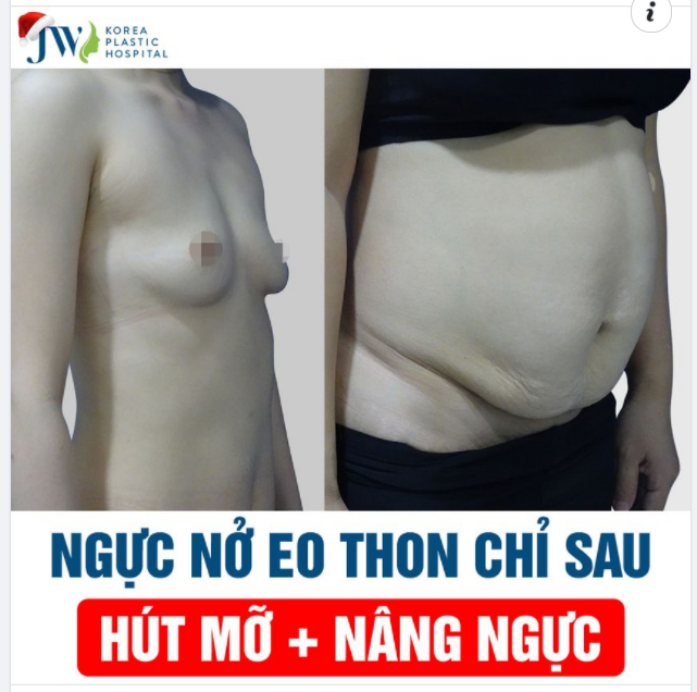 DÁNG ĐẸP NUỘT NÀ CHUẨN HOA HẬU BẰNG COMBO NÂNG NGỰC+HÚT MỠ BỤNG