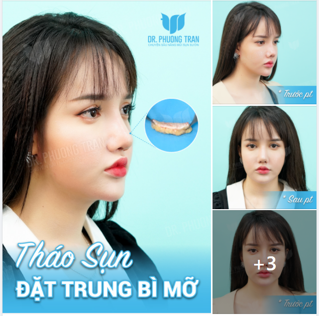 ĐẶT TRUNG BÌ MỠ - TÁI TẠO SAU THÁO CHẤT LIỆU CHO MŨI BIẾN CHỨNG