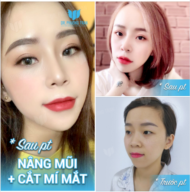 “DẬY THÌ THÀNH CÔNG” NHỜ COMBO NÂNG MŨI + LÀM MÍ MẮT
