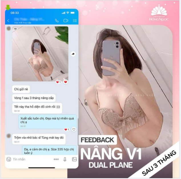 "Đẹp mà tự nhiên lắm ạ. Tết này tha hồ diện đồ xinh" - Feedback vô cùng chân thực của KH Hà Anh sau 3 tháng nâng V1
