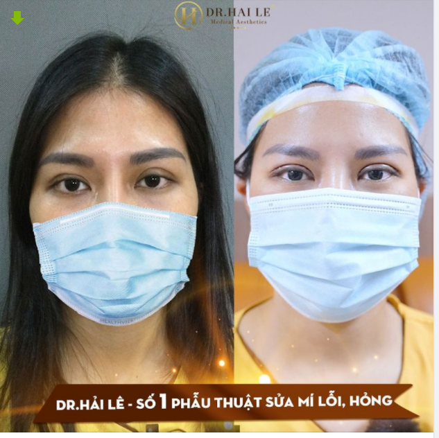 ĐIỀU GÌ THUYẾT PHỤC KHÁCH HÀNG ĐẾN DR.HẢI LÊ ĐỂ “SỬA MÍ” SAU KHI CẮT TẠI CƠ SỞ THIẾU UY TÍN ?