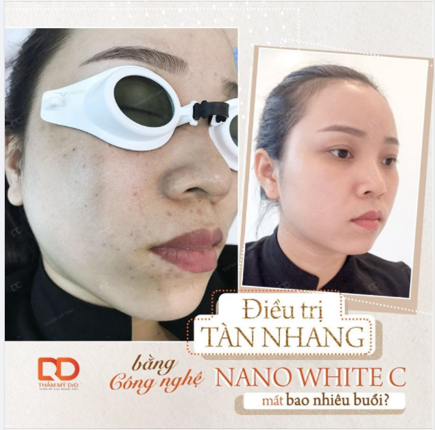 ĐIỀU TRỊ TÀN NHANG BẰNG CÔNG NGHỆ NANO WHITE C MẤT BAO NHIÊU BUỔI?