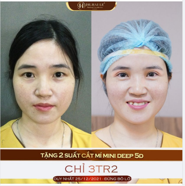 Đôi mắt được coi là “cửa sổ tâm hồn” và nằm ở vị trí trung tâm của khuôn mặt, việc thay đổi đôi mắt có thể khiến thần thái tươi trẻ hơn rất nhiều.
