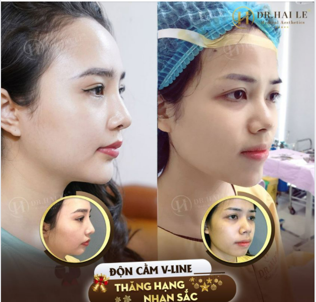 ĐỘN CẰM V-LINE - Một thay đổi nhỏ nhưng quan trọng giúp nàng xinh đẹp hơn nhiều
