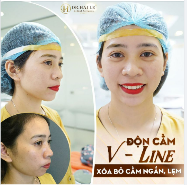 ĐỘN CẰM V-LINE - TRỞ THÀNH PHIÊN BẢN ĐẸP NHẤT CỦA CHÍNH MÌNH