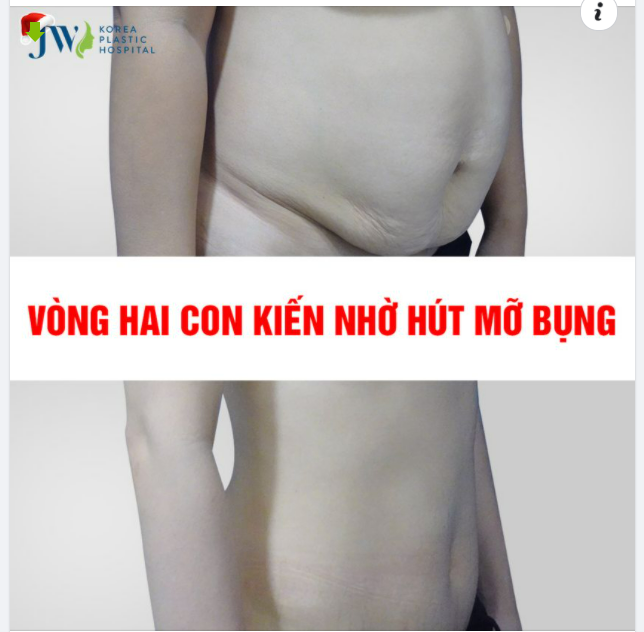 DỌN MỠ THỪA ĐÓN EO THON NHỜ HÚT MỠ BỤNG KẾT HỢP CÔNG NGHỆ RF