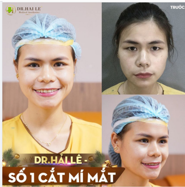 DR.HẢI LÊ SỐ 1 CẮT MÍ MẮT.!