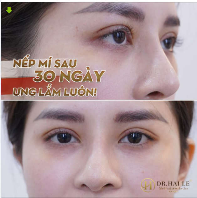 DR.HẢI LÊ - SỐ 1 CẮT MÍ MẮT