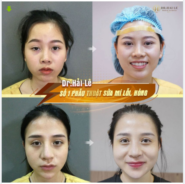Dù ai nói ngả nói nghiêng Hải Lê sửa mí vẫn là "đình cao"