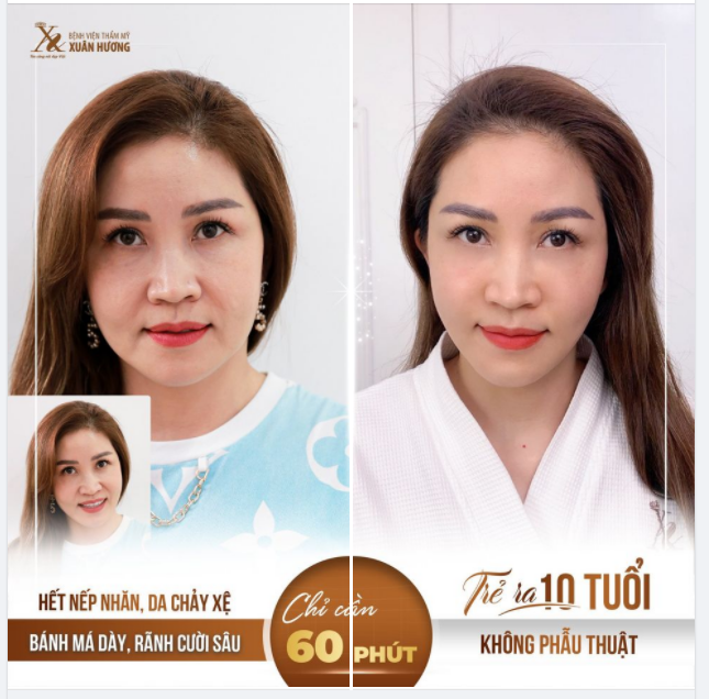 GẦN TẾT KHÁCH HÀNG ĐẾN XUÂN HƯƠNG NÂNG CƠ XÓA NHĂN NGÀY CÀNG NHIỀU