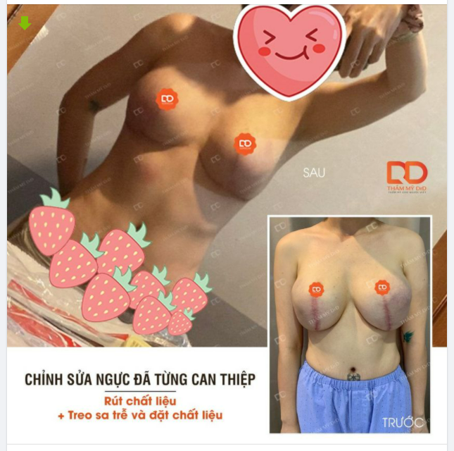 "Giải cứu" V1 đã từng can thiệp phẫu thuật "hỏng" Sự thay đổi khác biệt sau khi thực hiện phẫu thuật: