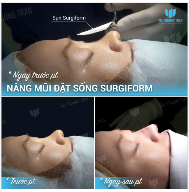 GIẢI PHÁP CHO CHIẾC MŨI “SIÊU VÕNG”