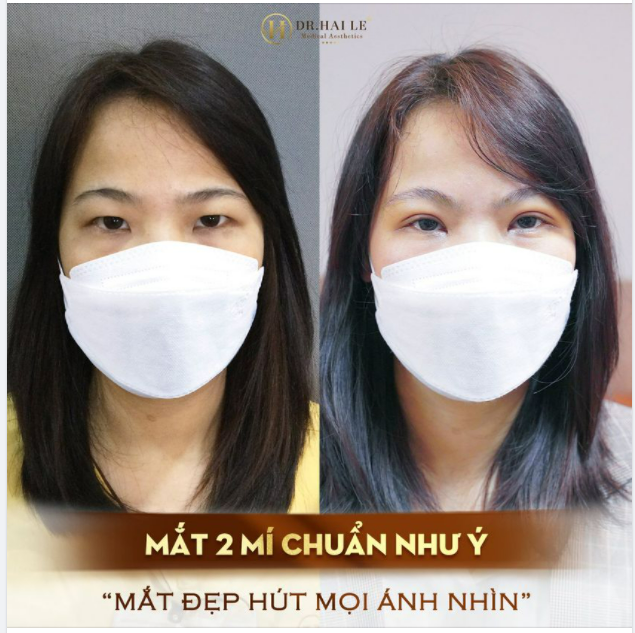 GIẢI PHÁP VÀNG CHO ĐÔI MẮT “MỘT MÍ"!