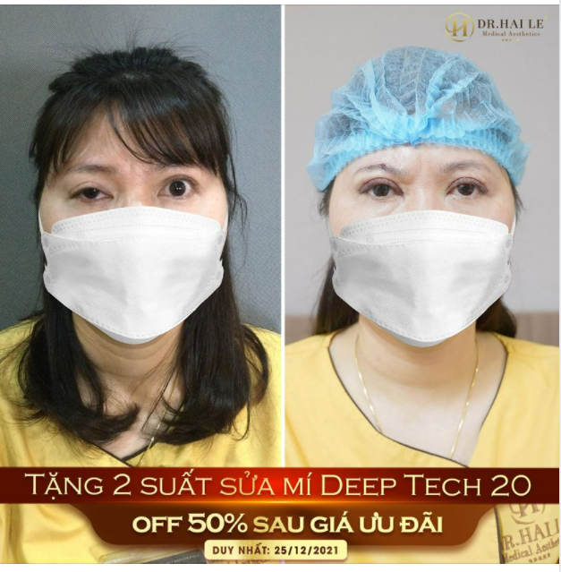 HẠ NẾP MÍ - PHỤC HỒI CƠ NÂNG MI - GIẢI PHÓNG SẸO CO RÚT