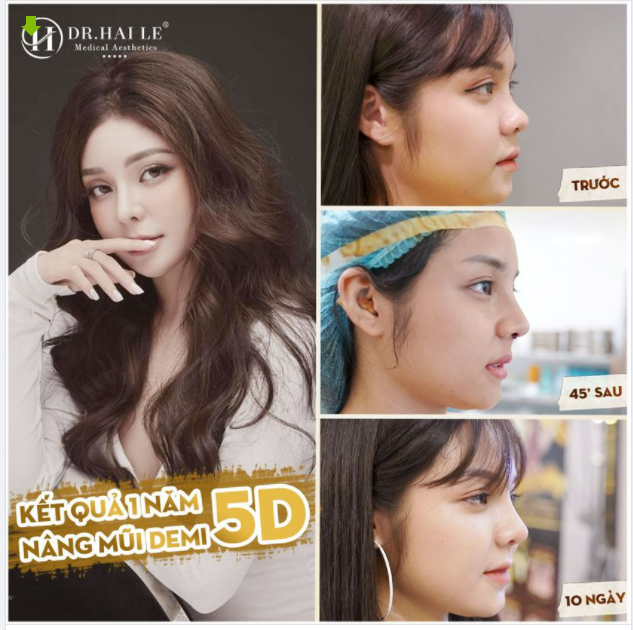 "HÀNH TRÌNH" THAY ĐỔI DIỆN MẠO SAU NÂNG MŨI DEMI 5D Dáng mũi đẹp "chanh sả" của Hotgirl Hải Yến