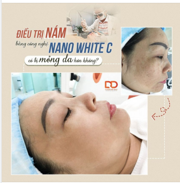 "Hết được nám mà da mỏng hơn thì thà bị nám còn hơn"