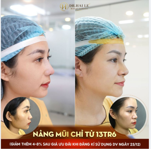 Kết quả "ai nhìn cũng mê" với thẩm mỹ Nâng mũi tại Dr.Hải Lê