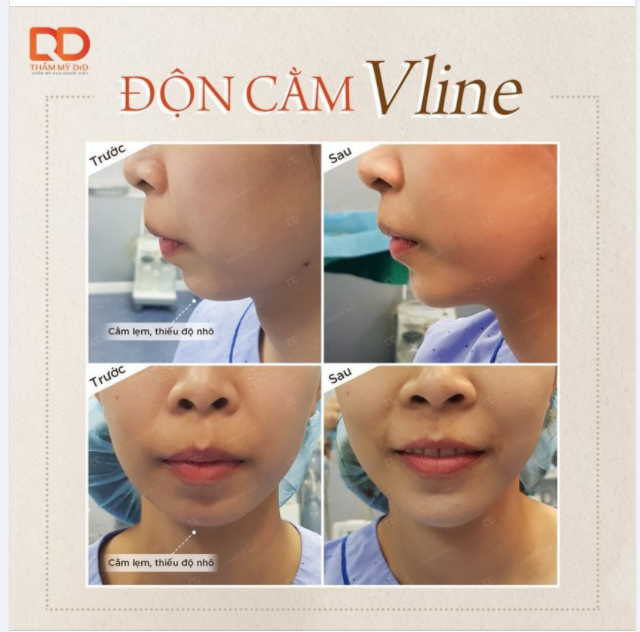Không phức tạp, không cầu kì, chỉ cần 1 tác động có ngay chiếc cằm Vline thời thượng.