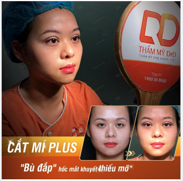 Lại là thiếu mỡ hốc mắt. Cứ tưởng tình trạng này ít gặp nhưng lại gặp nhiều không tưởng.