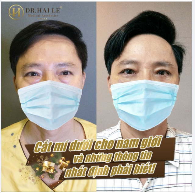 LÀM ĐẸP BÂY GIỜ KHÔNG CHỈ DÀNH RIÊNG CHO PHÁI NỮ CẮT MẮT MÍ DƯỚI NAM GIỚI - NÍU THANH XUÂN!