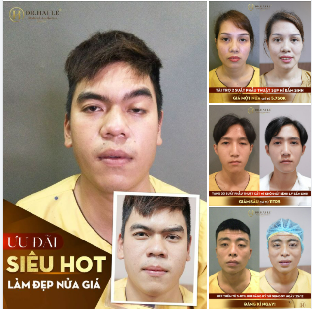 LÀM GÌ MÀ PHẢI "HỐT" 60 PHÚT PHẪU THUẬT CHỮA SỤP MÍ BẨM SINH - MẮT ĐẸP HÚT HỒN, INBOX NGAY!