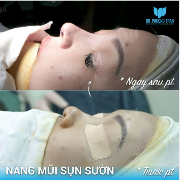 “LÀM MỚI” MỘT CA MŨI GỒ GHỀ