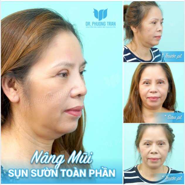 LỚN TUỔI CÓ NÂNG MŨI SỤN SƯỜN ĐƯỢC KHÔNG?