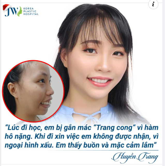 “Lúc đi học, em bị gắn mác “Trang cong” vì hàm hô nặng. Khi đi xin việc, em không được nhận vì ngoại hình xấu. Em thấy buồn và mặc cảm lắm”. – Huyền Trang