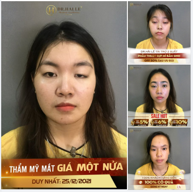 Mặc cảm, stress, tự ti, không dám gặp gỡ ai...là tâm lí chung của Khách hàng bị sụp mí bẩm sinh.