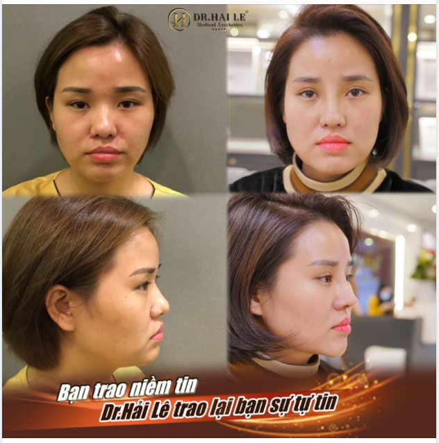 Mãn nhãn với DEMI 5D - 10 ngày tại Dr.Hải Lê!