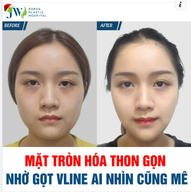 MẶT TRÒN HÓA THON GỌN NHỜ GỌT VLINE AI NHÌN CŨNG MÊ