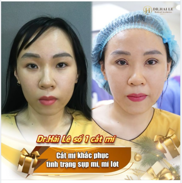Mí lót "hoá" hai mí ​​​​​​​ Không đau - không sẹo - nếp mí bền đẹp tự nhiên