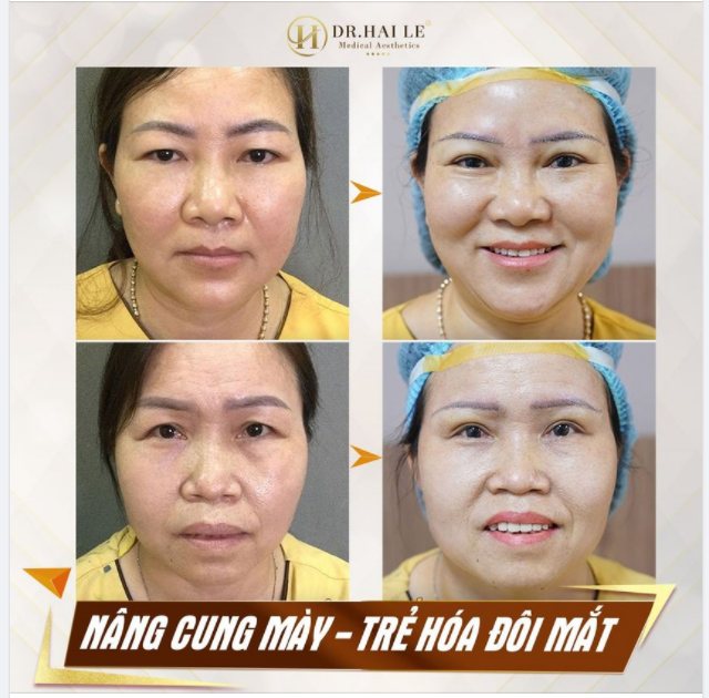 MÍ MẮT VÀ SỰ GIA TĂNG MỠ THỪA THEO TUỔI TÁC!