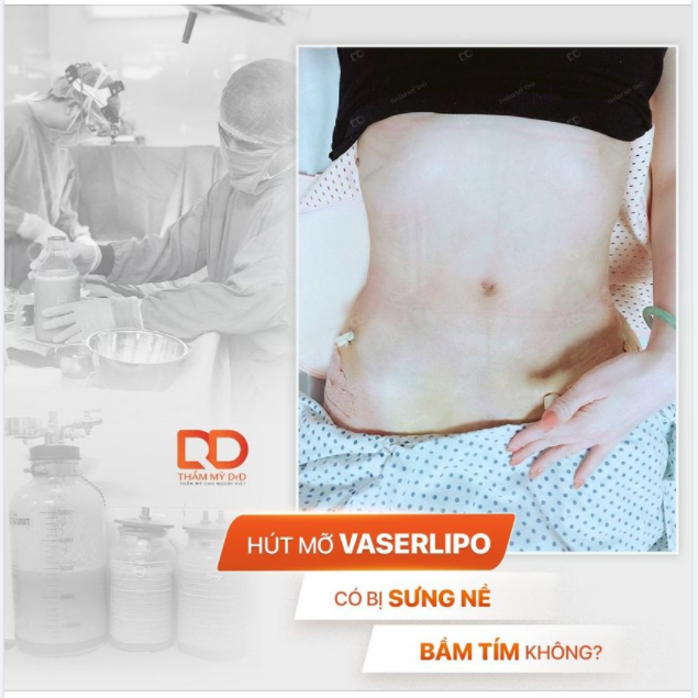 Một "chiếc" bụng phẳng, chẳng lo sưng bầm. Đừng bỏ qua Công nghệ hút mỡ Vaserlipo - Số 1 về tính an toàn và hiệu quả sau thực hiện.