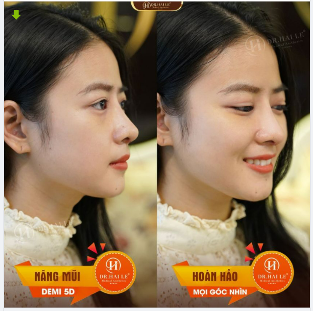 MỘT DÁNG MŨI ĐẸP THEO TIÊU CHUẨN TỶ LỆ VÀNG CẦN ĐÁP ỨNG ĐƯỢC NHỮNG GÌ?
