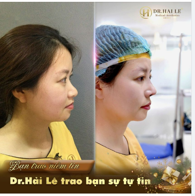 MŨI CAO SANG - ĐẸP TỰ NHIÊN