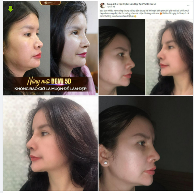 Mũi chân thật đến từng chi tiết có lẽ chỉ có tại Dr.Hải Lê mới có thể mang đến dáng mũi hợp với khuôn mặt chuẩn từng ly như vậy
