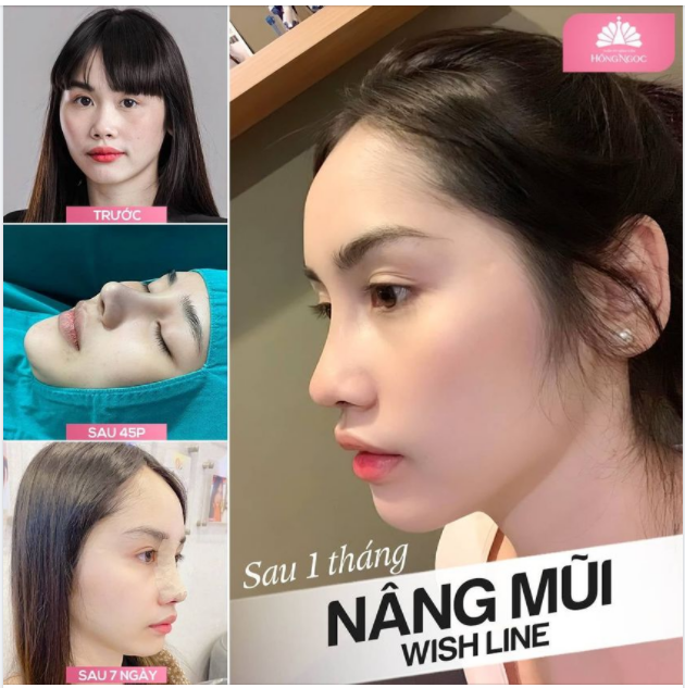 MŨI ĐẸP LUNG LINH - ĐÓN GIÁNG SINH RẠNG RỠ